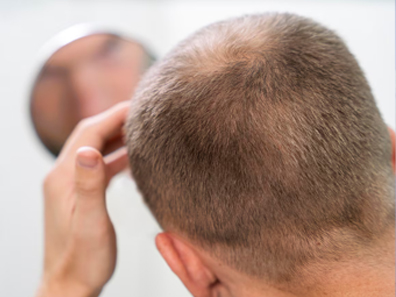 hair regrowth treatment janakpuri