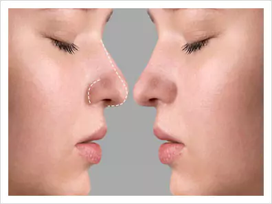type of nose surgery
